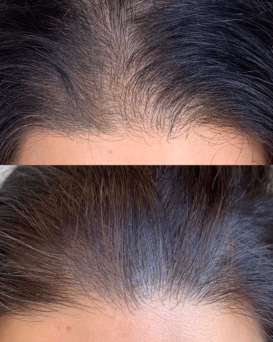 Antes y después de una micropigmentación capilar en el Estudio Antonella Paludi