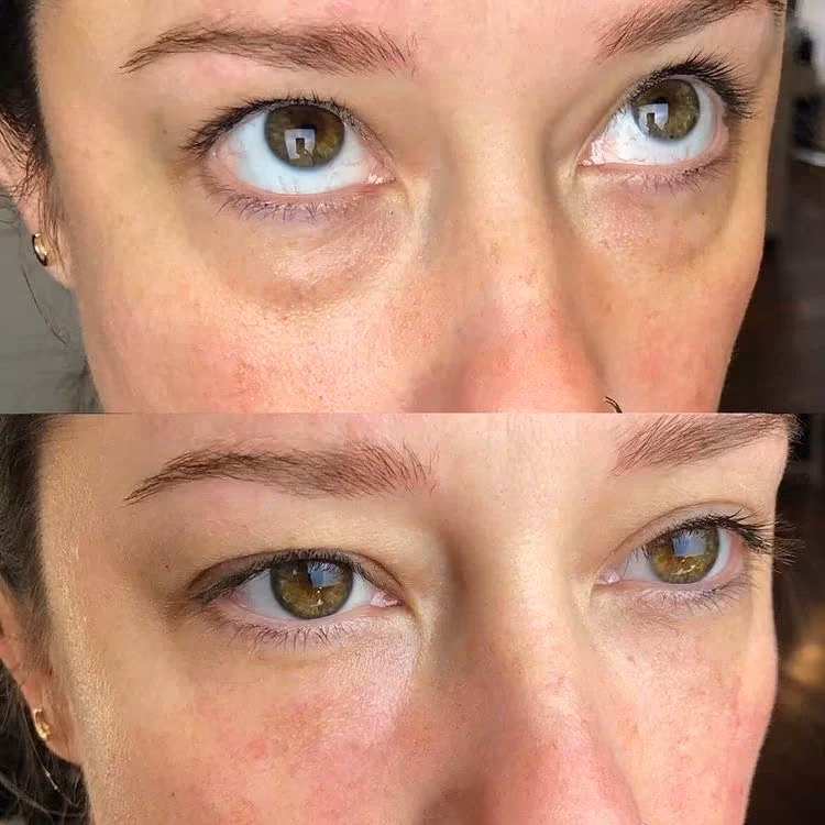 Antes y después de un aclarado de ojeras en el Estudio Antonella Paludi
